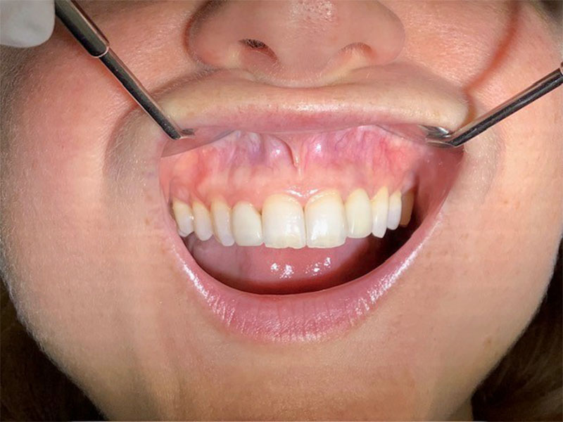 Vier Frontzahnimplantate (nachher)