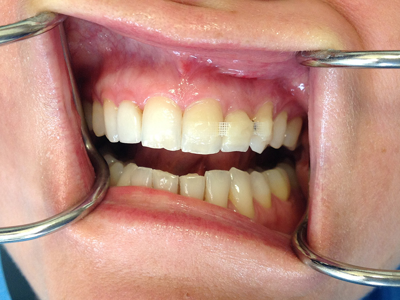 Vier Frontzahnimplantate (vorher)