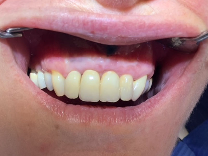 Frontzahn-Einzelimplantat (nachher)