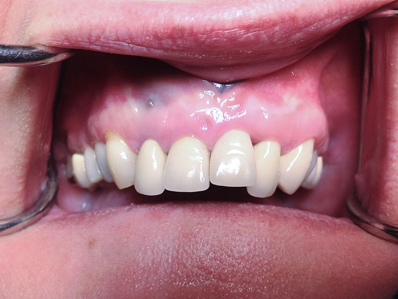 Frontzahn-Einzelimplantat (vorher)