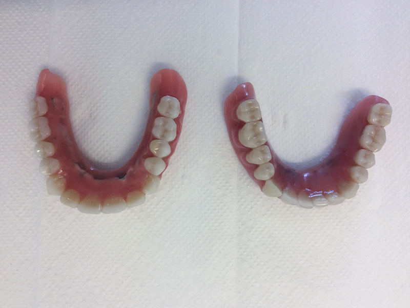 Herausnehmbare Brücken auf Implantaten