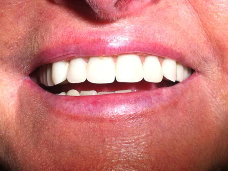 Implantatabgestützte herausnehmbare Brücke (Ober- und Unterkiefer)