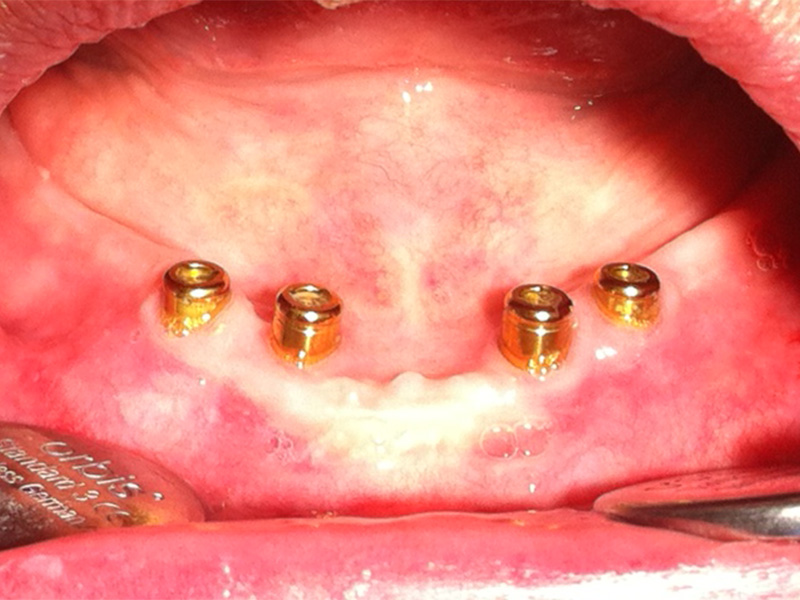 Implantate für zahnlosen Unterkiefer (nachher)