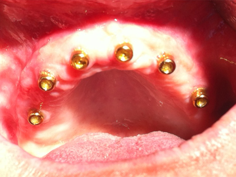 Implantate für zahnlosen Oberkiefer (nachher)