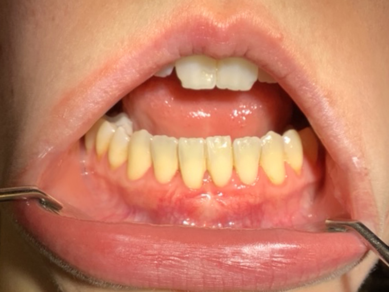 Zahnfleischrückgang (Rezessionen) Unterkiefer / Frontzähne (nachher)