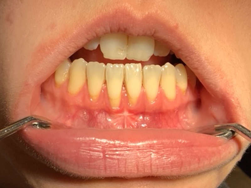 Zahnfleischrückgang (Rezessionen) Unterkiefer / Frontzähne (vorher)