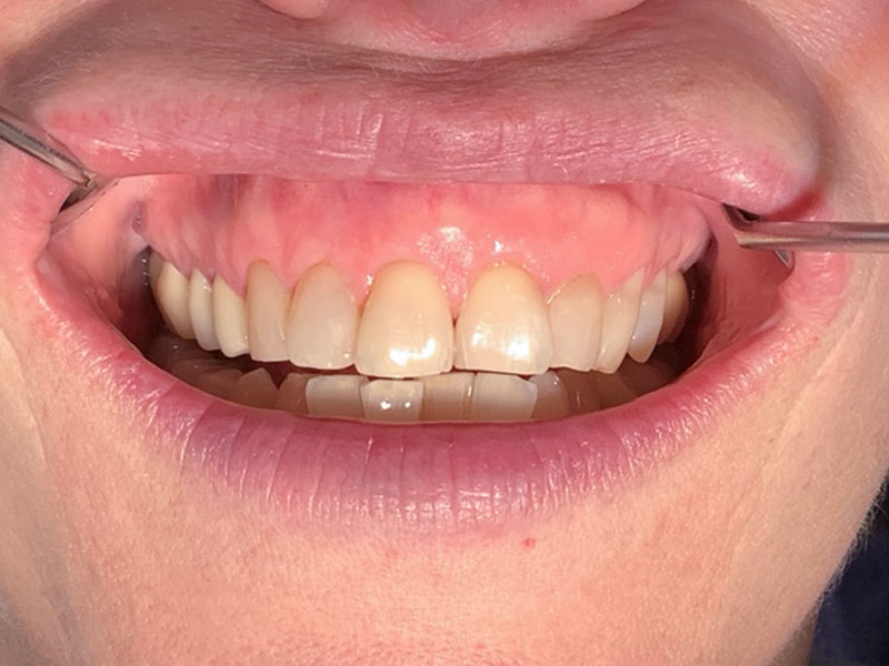 Zahnfleischrückgang (Rezessionen) Oberkiefer / Frontzähne (nachher)