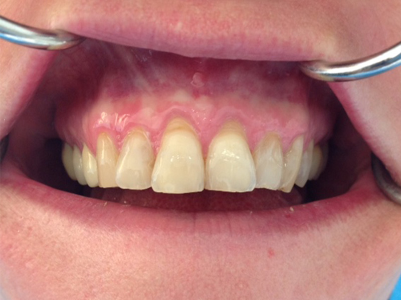 Zahnfleischrückgang (Rezessionen) Oberkiefer / Frontzähne (vorher)