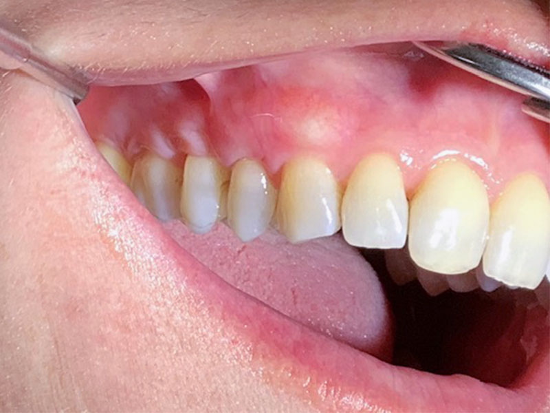 Zahnfleischrückgang Seitenzähne links (nachher)