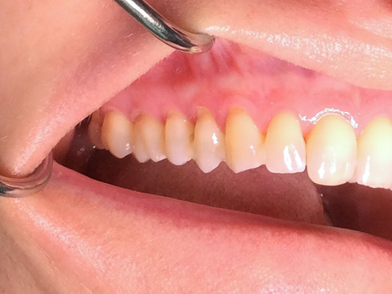Zahnfleischrückgang Seitenzähne links (vorher)