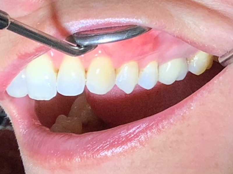 Zahnfleischrückgang Seitenzähne rechts (nachher)