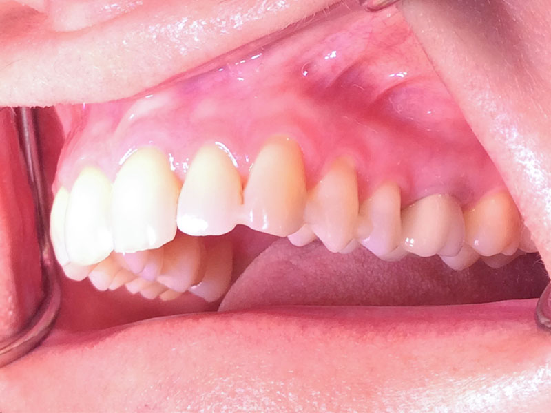 Zahnfleischrückgang Seitenzähne rechts (vorher)
