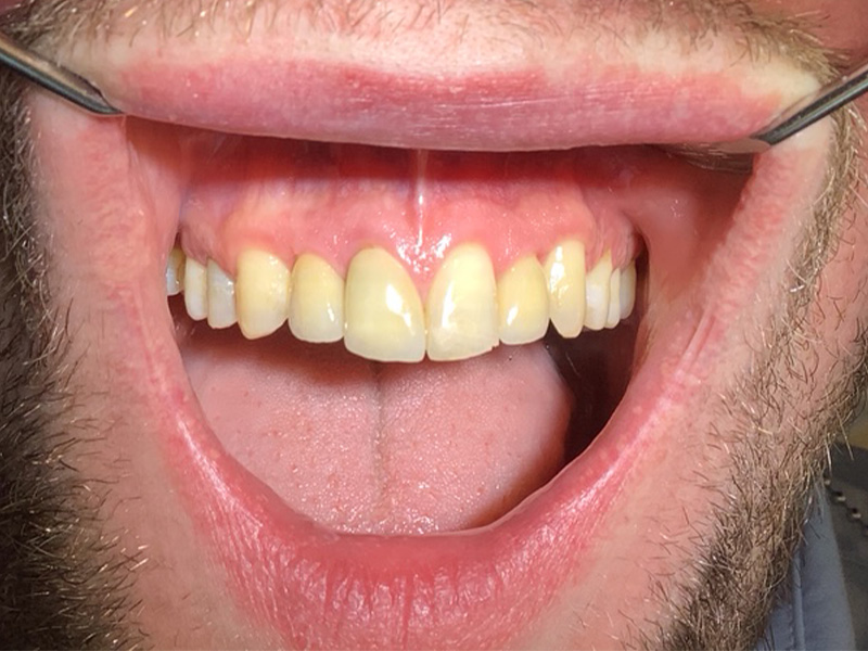 Nichtanlagen der seitlichen Schneidezähne (nachher)