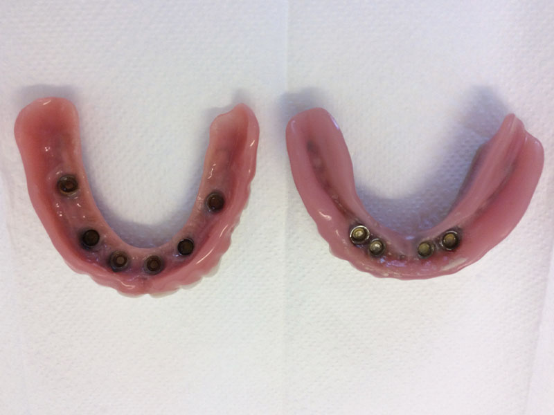 Herausnehmbare Brücken auf Implantaten