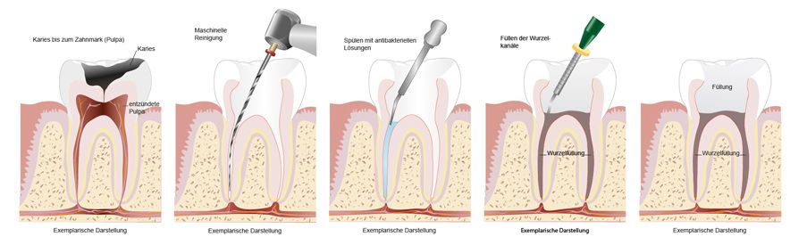 Wurzelkanalbehandlung